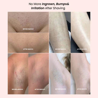 Before and after results showing no more ingrown bumps and irritation after using dual head bikini trimmer.